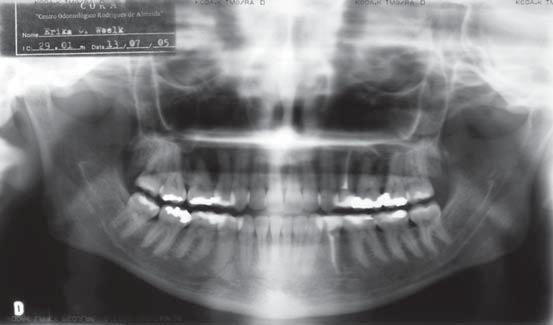 Serial extraction in orthodontics: indications, objectives, and