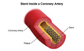 Coronary Syndromes Shock