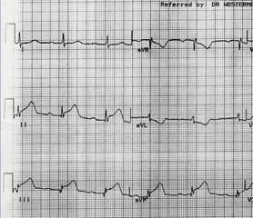 What a 12-Lead ECG can