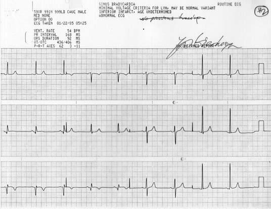 anterior infarct (no Qs) Worsened ST