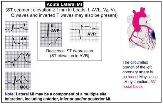 Acute R Ventricle 