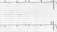 12 EKG follows. What treatment?