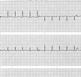 P waves Limitations of a 12-Lead ECG