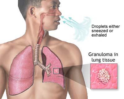 Lungs=entry portal Inhalation of droplet nuclei Coughing: 3000 droplet nuclei/cough Talking: 5 minutes Sneezing: BEST TRANSMISSION TRANSMISSION