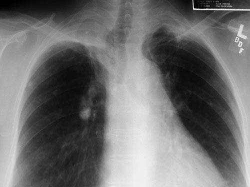 Primary Infection with Resolution: 85% of Cases Patient asymptomatic/ viral syndrome Enlargement of hilar/ peribronchial nodes Ghon complex: hilar node calcification Positive PPD 6-12 weeks Primary
