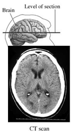 Computerized axial tomography (CAT or CT scan): type of X-ray; pictures brain in slices (right) Magnetic resonance imaging (MRI)