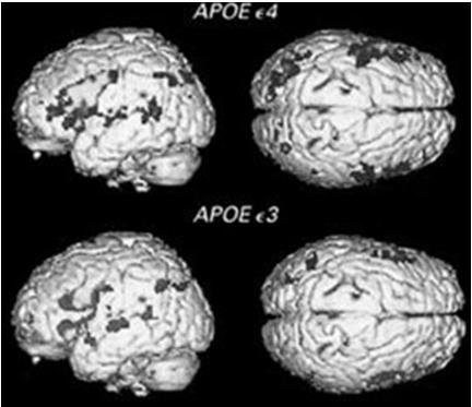 FUNCTIONAL MRI AND ALZHEIMER S Brain activation during memory task for group with gene related to Alzheimer disease (top) and group without gene (middle) Both groups normal, but more activation in