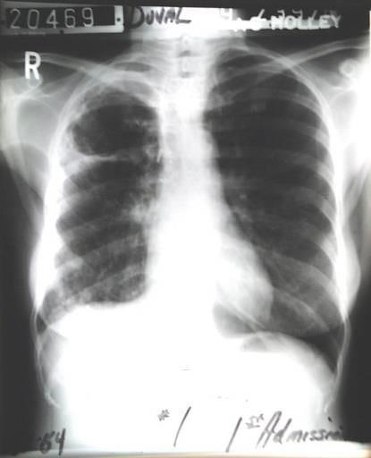 Chest x-ray Diagnosis of TB Disease 95% of HIV(-)
