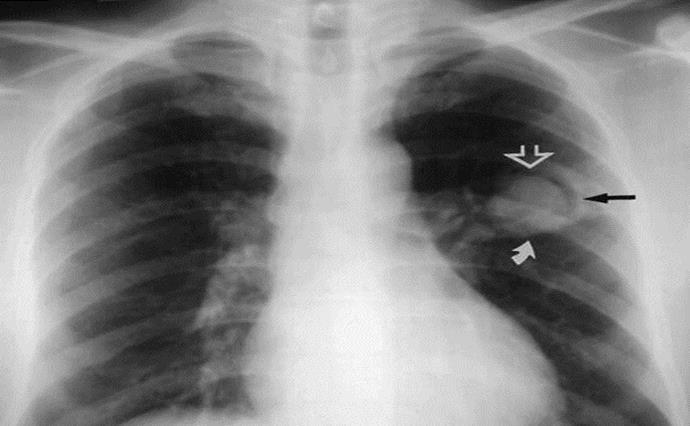 Factors increasing risk of tuberculosis Infectiousness of the source case Smear positive > smear negative Intensity of exposure Increased duration of exposure Closer contact with patient in a closed