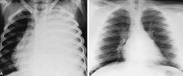 5-year-old boy with massive left pleural effusion caused by tuberculosis.
