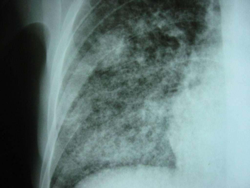Miliary TB: 1-2 mm rounded