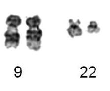 BCR-ABL Ph Chromosome resulting from t(9;22)(q34;q11) BCR-ABL fusion protein: main 2 distinct molecular weight : p210 and p190