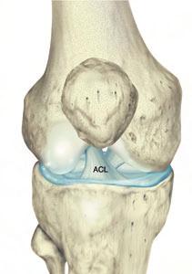 What is an ACL Tear? The ACL (anterior cruciate ligament) is the main anterior stabilizer of the knee.