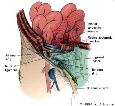Indirect Hernia Route Note: The hernia sac passes outside the boundaries of