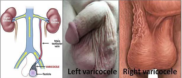 Varicocele A varicocele is a condition in which the veins of the pampiniform plexus are elongated and dilated.