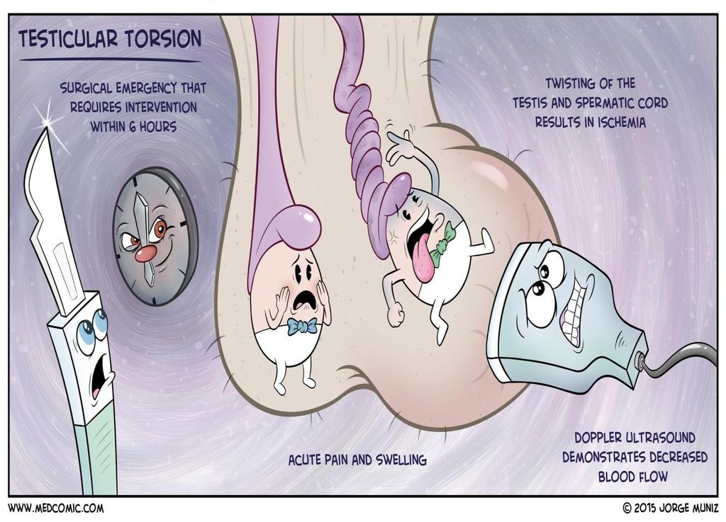 Torsion of the Testis Torsion of the testis is a rotation of the testis
