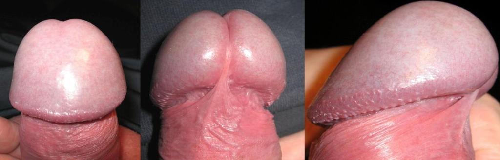 The skin of the penis Followed distally, the skin forms a loose fold called the prepuce or foreskin which covers the glans.
