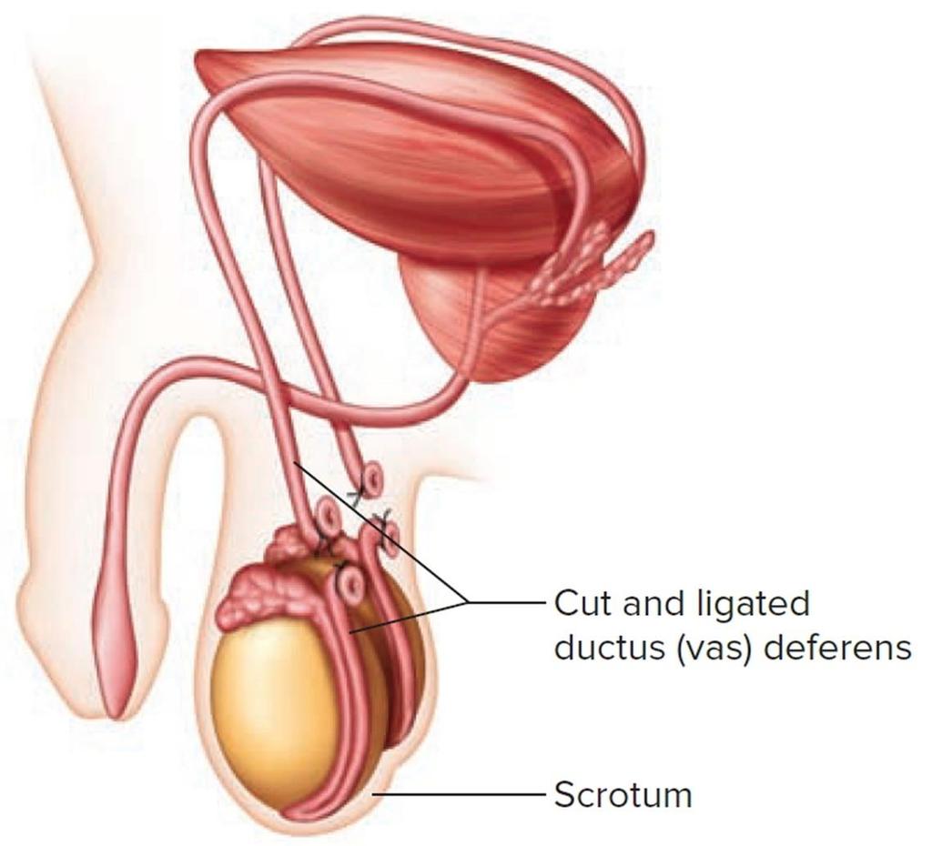 Ductus Deferens (Vas Deferens) It is thick walled muscular tube which springs from the lower end of the