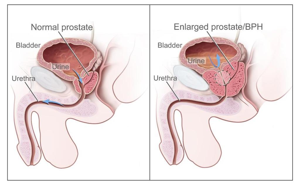 They are the usual sites for the senile enlargement of the prostate. Posterior lobe : lies behind the prostatic urethra, but below the two ejaculatory ducts. It is the usual site for cancer prostate.