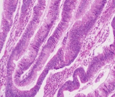 (c) Gastric-type adenoma is made up of columunar cells with basally-oriented nuclei, showing