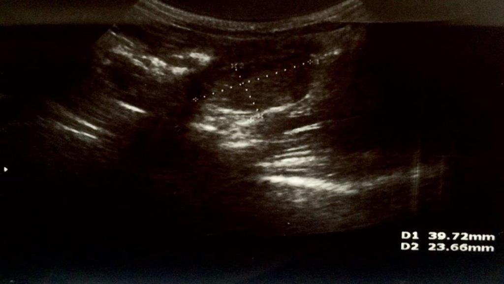Recurrent Ovarian Torsions in Children Fig. 3: Sonography of the patient with extended left ovary before surgery.