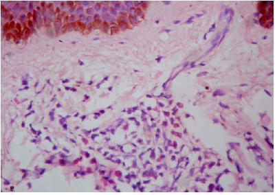 leukemic cells. H & E, 10x. FIG.5 Histopathology skin biopsy.