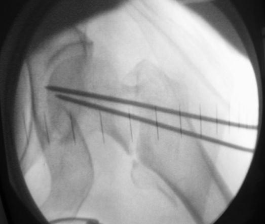 J Bone and Joint Surgery (A) 1991;73:1192-1199. [26]. O Brien PJ, Meck RN, Blachut PA, Sabharwal S.Sliding screw plate fixation of the intertrochanteric femoral fractures. J Trauma 1972;12:581-591.