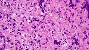 be positive in some lymphomas 1.