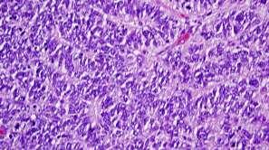 PNET of germ cell tumor origin lacks chr 22