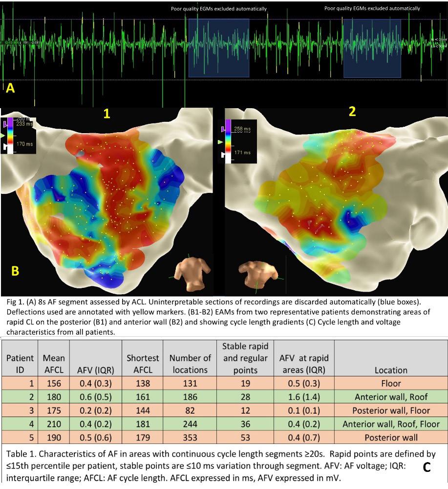S526 Heart Rhythm, Vol. 15, No. 5, May Supplement 2018 911±477 sampled endocardial points corresponded to regional LGE with IIR>1.2. Conclusion: LGE with IIR > 1.