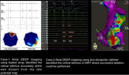 DEEP mapping could particularly be useful if the clinical arrhythmia could not be induced during ablation Objective: To assess the utility of DEEP mapping in identifying the IART ablation targets.