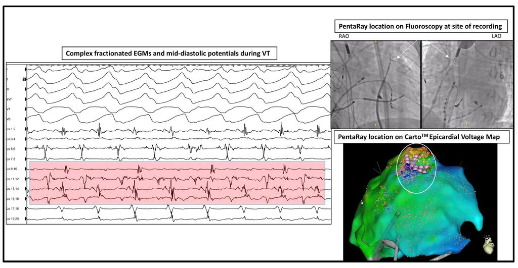 S584 atypical atrial flutter. Prior ablations included pulmonary vein isolation, rotor ablation, an anterior mitral annular (MA) line, CTI line, a roof line and posterior wall isolation.