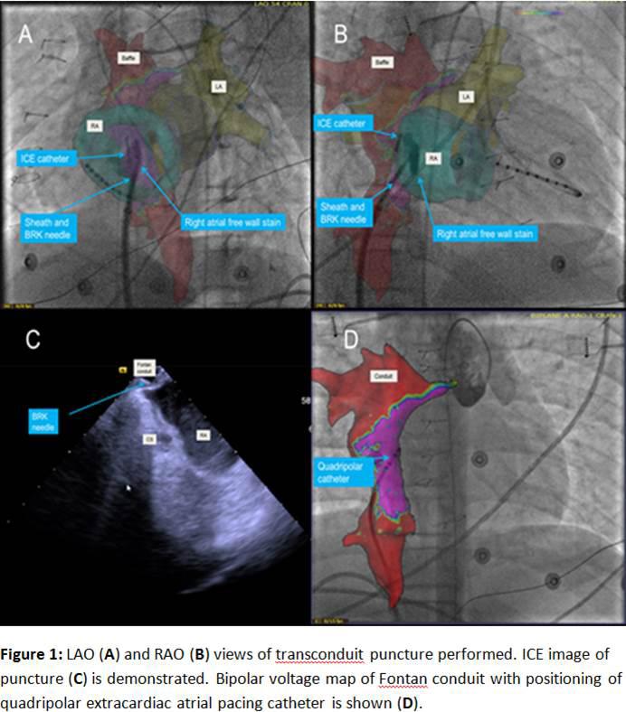This finding has implications for placement of extracardiac permanent atrial pacing lead as bipolar voltage map can localize viable targets, particularly for patients unable to have transpulmonary