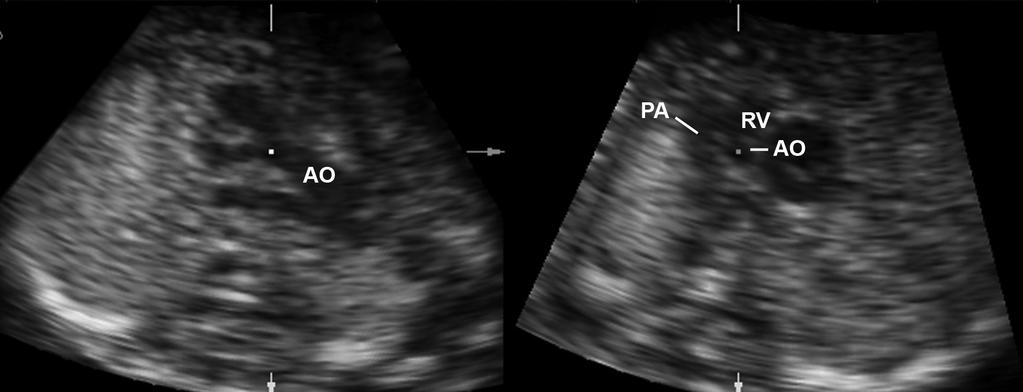 Ebstein anomaly with pulmonary atresia, hypoplastic left heart syndrome, situs inversus with an atrioventricular canal, a persistent left superior vena cava (Figure 3), and a ventricular septal
