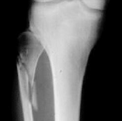 Fracture Evaluation In a child, the healthy opposite side occasionally