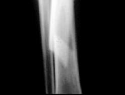 lateral at fracture Slight medial displacement distal fragment