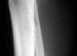 Lower Leg Fracture Lateral View Posterior