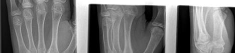 included Forearm Fracture No angulation