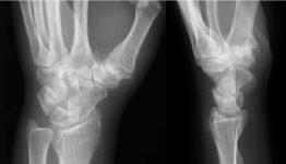 T Type Fracture