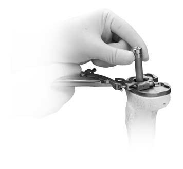 Use the MIS 6 mm hex screwdriver to completely hand tighten the threaded MIS drop down stem extension into the MIS tibial component (until head is below plate surface).