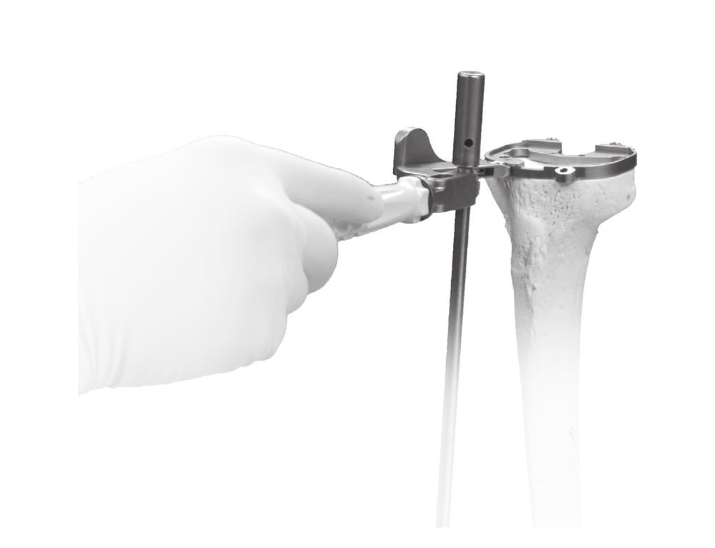 Tibial plate rotation and varus/valgus alignment can be checked by inserting the alignment rod through the hole or slot in the handle of the MIS sizing plate handle (Figure 8).