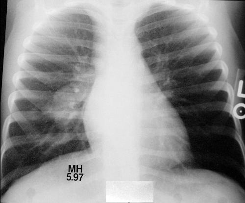 Chest radiograph Two-view chest radiograph helps identify common abnormality: Intrathoracic lymphadenopathy Mention symptoms and possibility of TB on