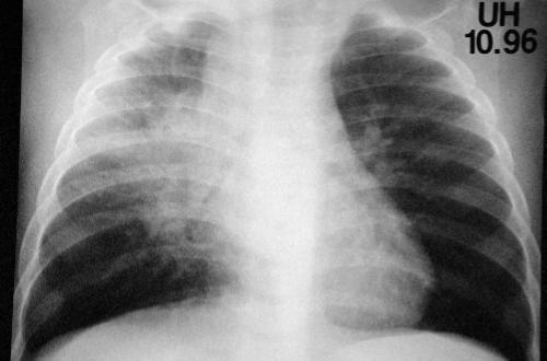 Summary: Child contact Prompt TST / IGRA and symptom review for all individuals with significant exposure to contagious TB case Children under 5 yrs or immunocompromised Chest radiograph and physical