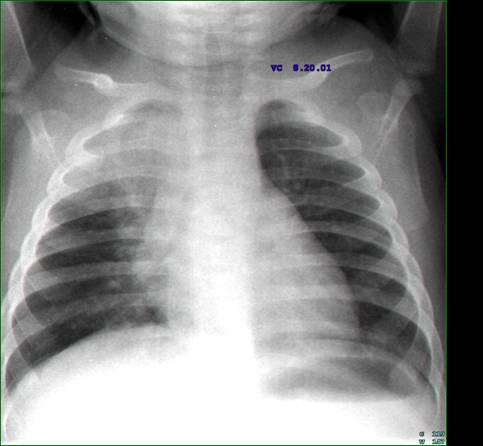 Assess the course of treatment At two months: Repeat chest radiograph and assess the situation.