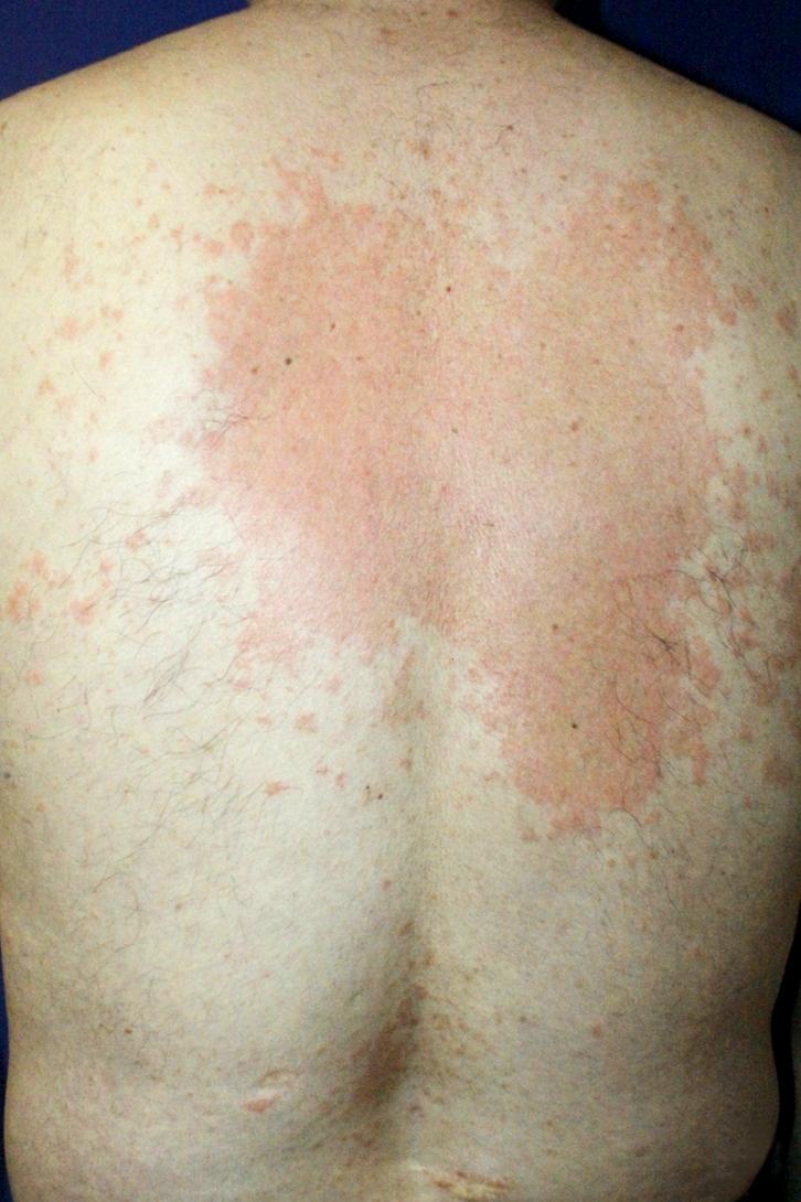 JM Kim, et al Fig. 2. (A) Representative image of erythematous wheals and papules on the back were observed at the first visit.