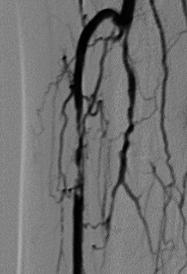 Popliteal: no significant stenosis