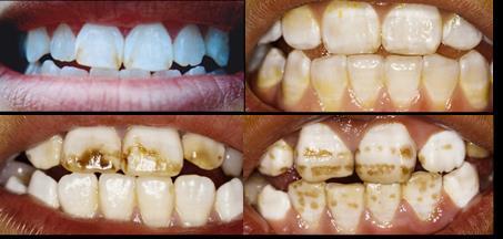 Dental Fluorosis Excess fluoride in children known to result in dental fluorosis Condition in which the teeth enamel becomes irreversibly damaged and the teeth become permanently discolored,
