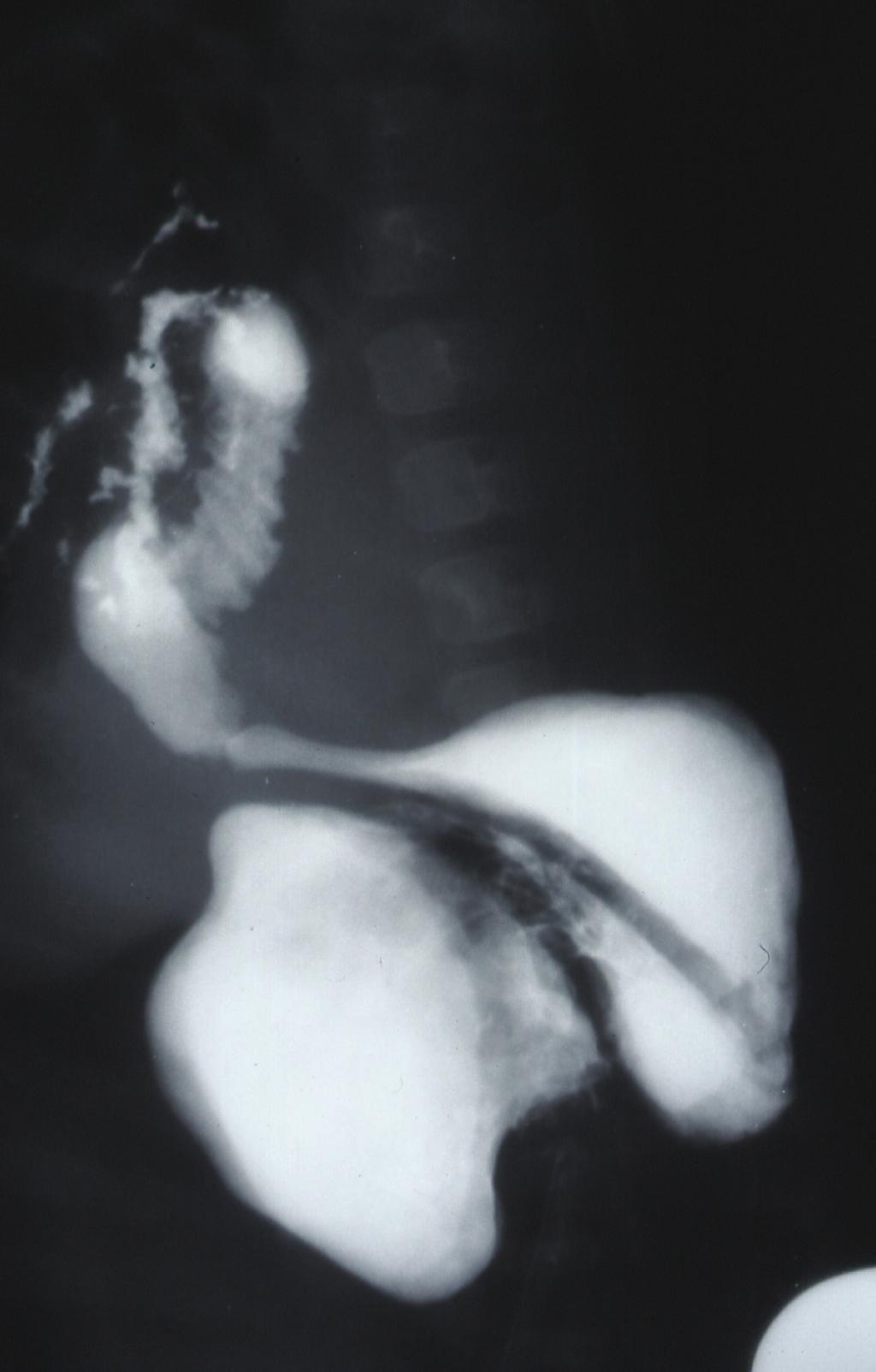 ISRN Surgery 3 (a) Figure 1: Barium meal showing a large paraesophageal hernia with herniation of the stomach into the chest and intrathoracic gastric volvolus.