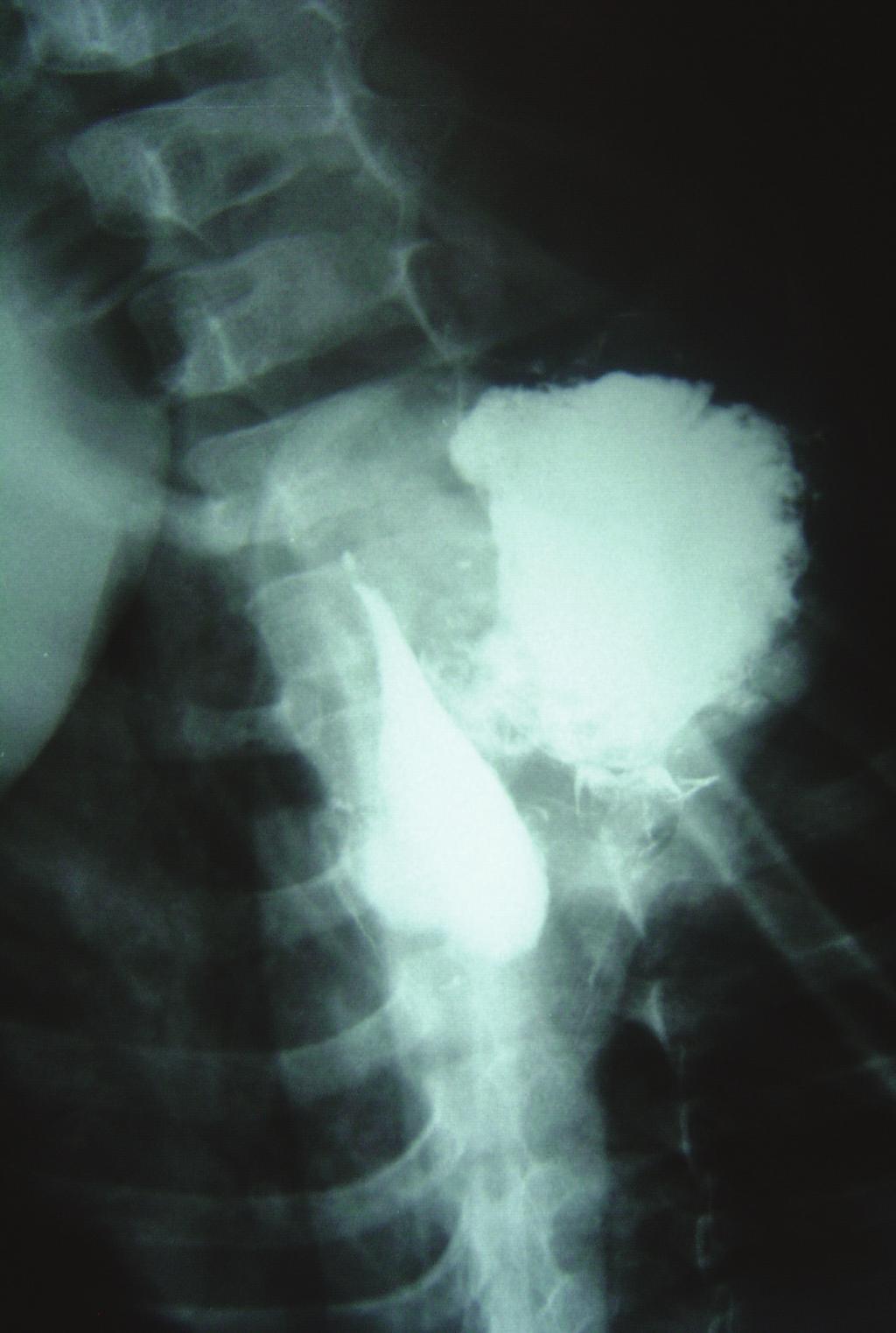 These may represent a combined type of sliding and paraesophageal hernias, or in the pediatric age group, congenital paraesophageal hernia is distinct and diﬀerent from its adult counterpart.