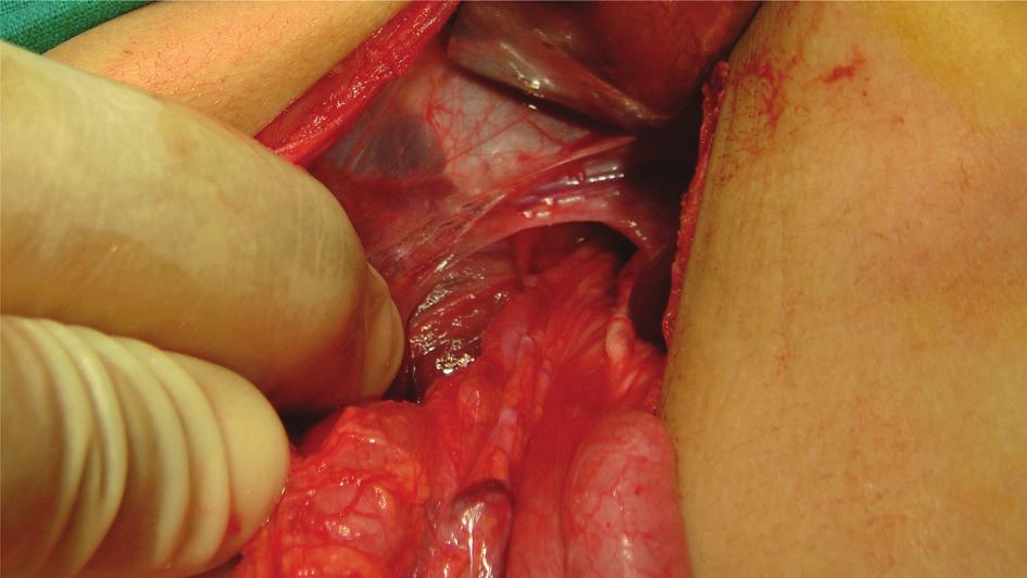 4 ISRN Surgery hernia repair [4]. This is supported by the fact that 12 (60%) of the 20 patients in Karpelowsky et al.